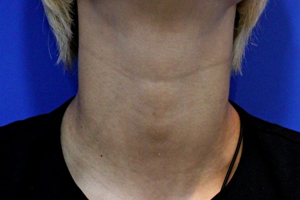 목주름 필러 + 보톡스 : 시술후 사진