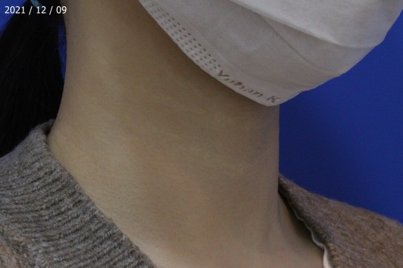 목주름 필러+보톡스 : 시술후 사진