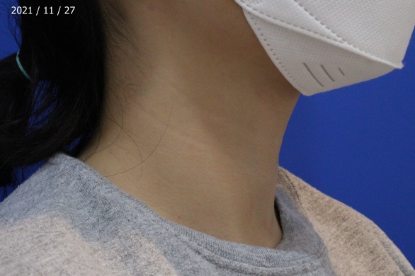 목주름 필러+보톡스 : 시술후 사진
