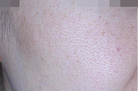 포텐자+엑소좀 모공 콜라겐 프로그램 : 시술후 사진