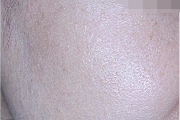 포텐자+엑소좀 모공 콜라겐 프로그램 : 시술후 사진