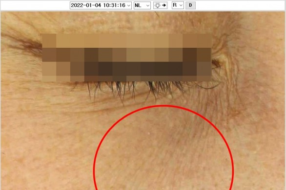 눈밑 잔주름_미라젯 : 시술후 사진