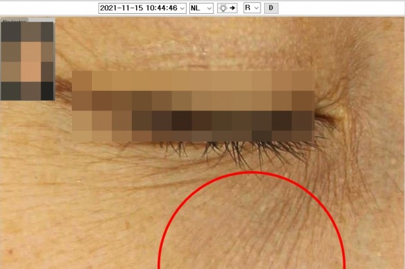 눈밑 잔주름_미라젯 : 시술후 사진