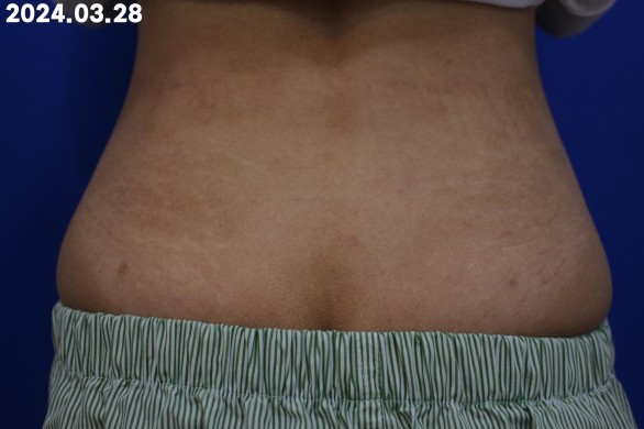 미라젯 튼살 치료 3회 후 등 흰튼살 개선 효과 : 시술후 사진