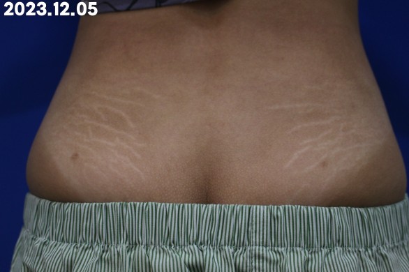 미라젯 튼살 치료 3회 후 등 흰튼살 개선 효과 : 시술후 사진