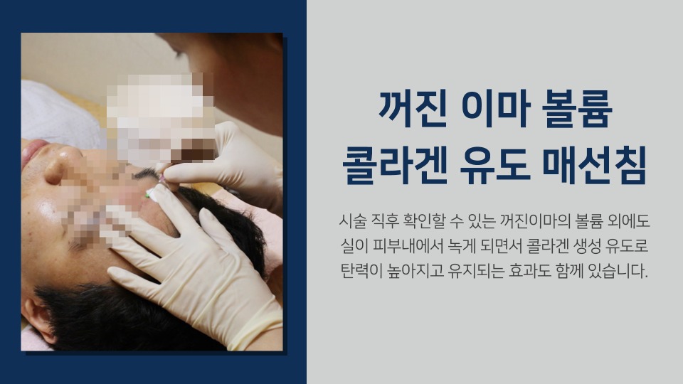 꺼진이마3.jpg